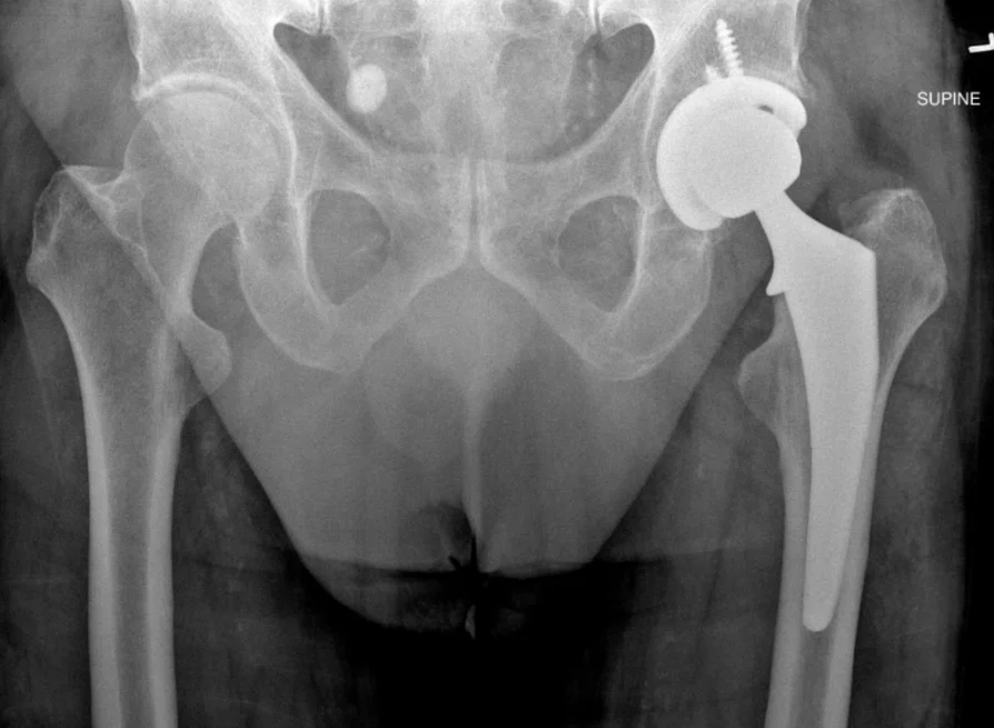 X-ray of a pelvis after a total hip replacement.