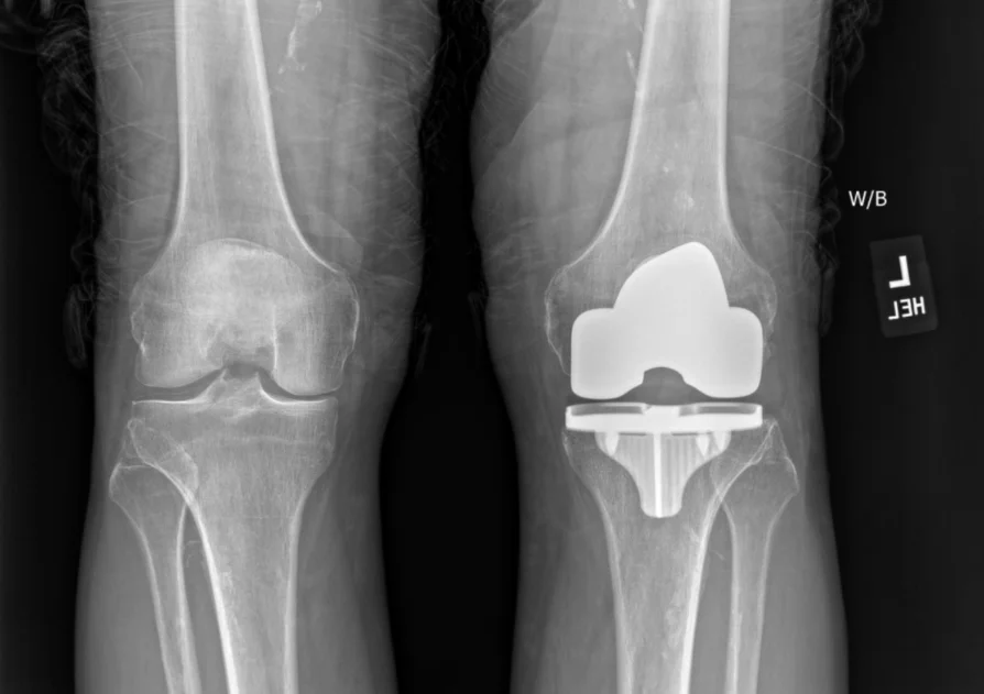 X-ray of both knees, one after a total knee replacement.